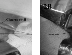 Thoracic cannulation venous duct