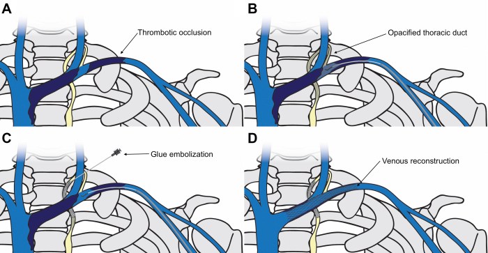 Thoracic duct relations lymphatic