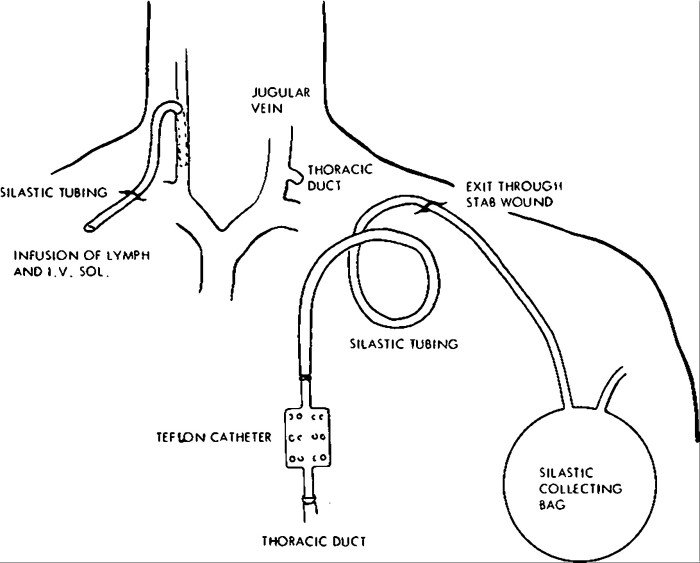 Cannulation of thoracic duct cpt code